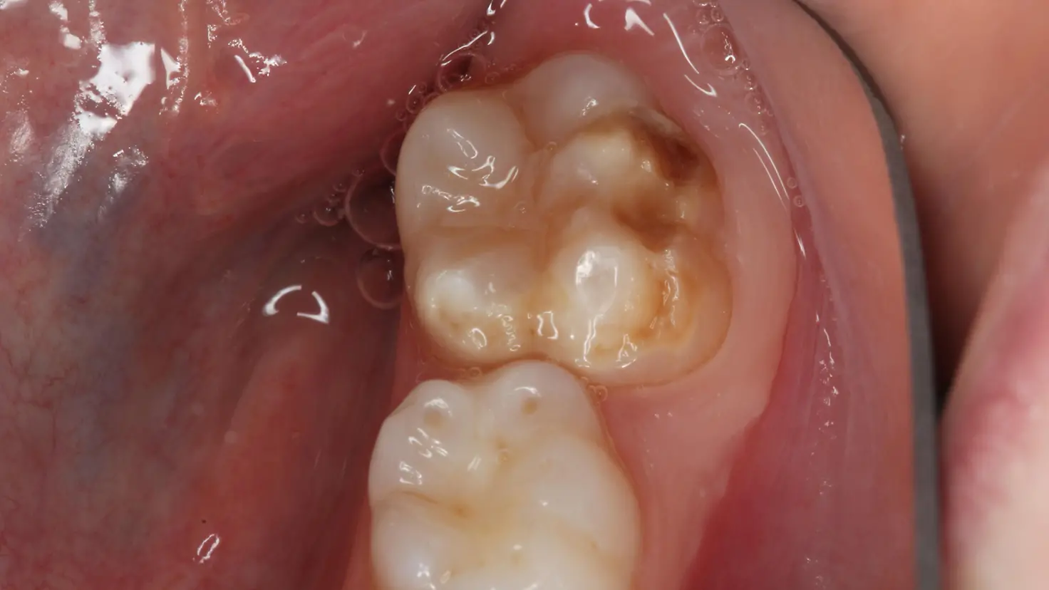 Blick in einen Kindermund mit Zähnen, die eine moderate Form der MIH aufweisen