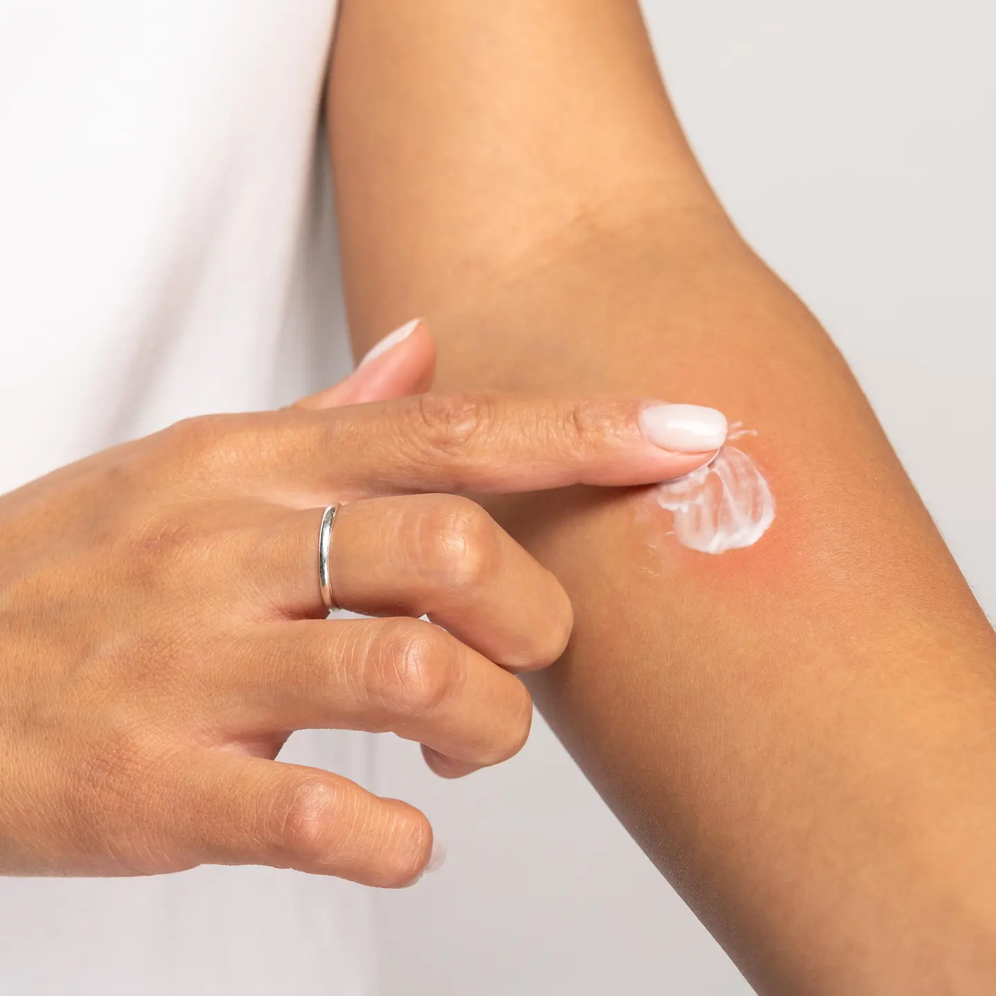 Eine Frau trägt Salbe auf einen Mückenstich am Arm auf.