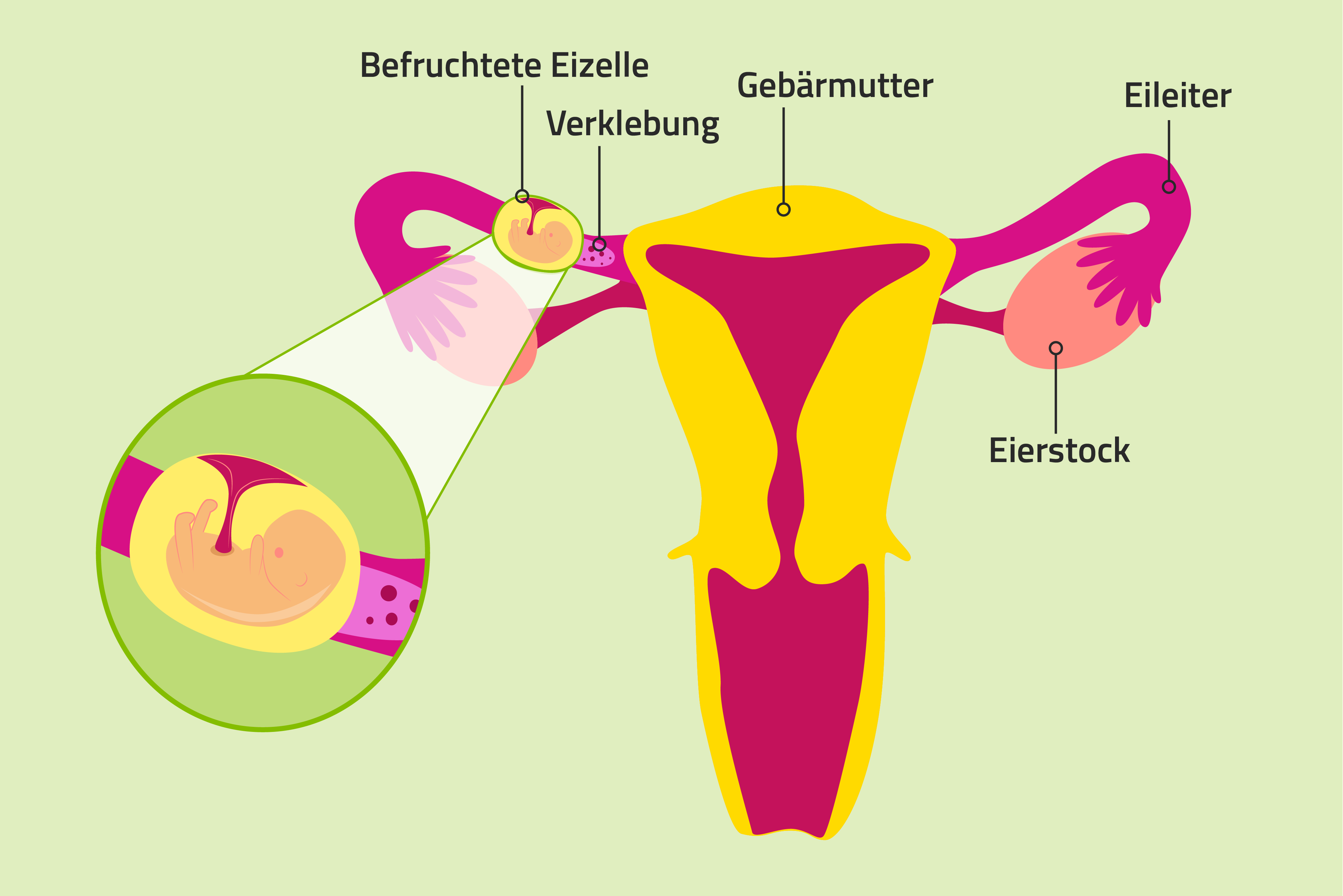 Illustration Eileiterschwangerschaft