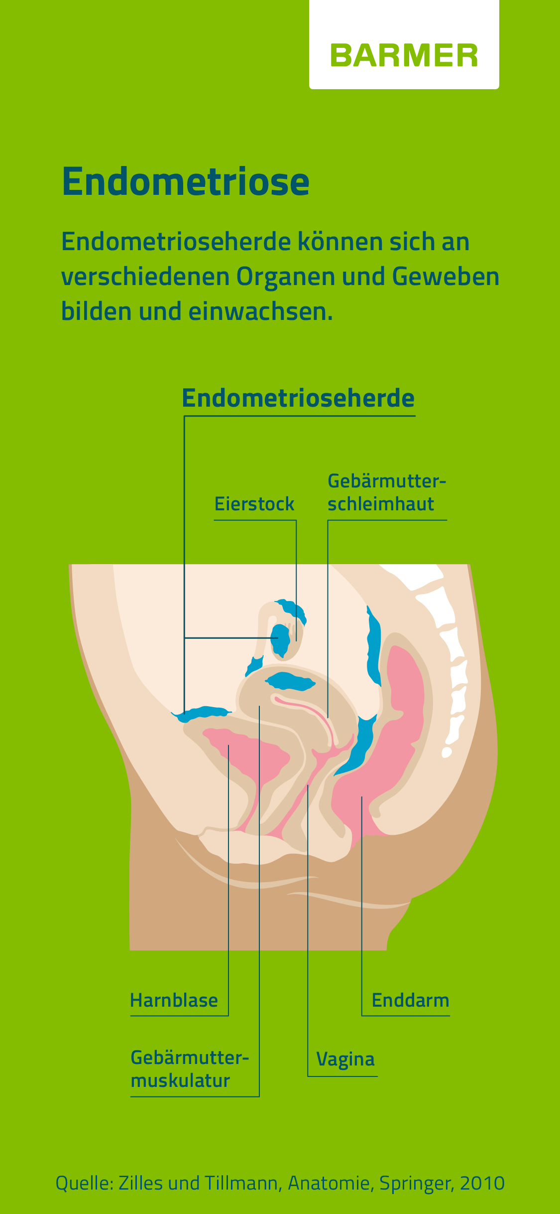 Illustration eines Querschnistts durch den weiblichen Unterleib mit Endometrioseherden