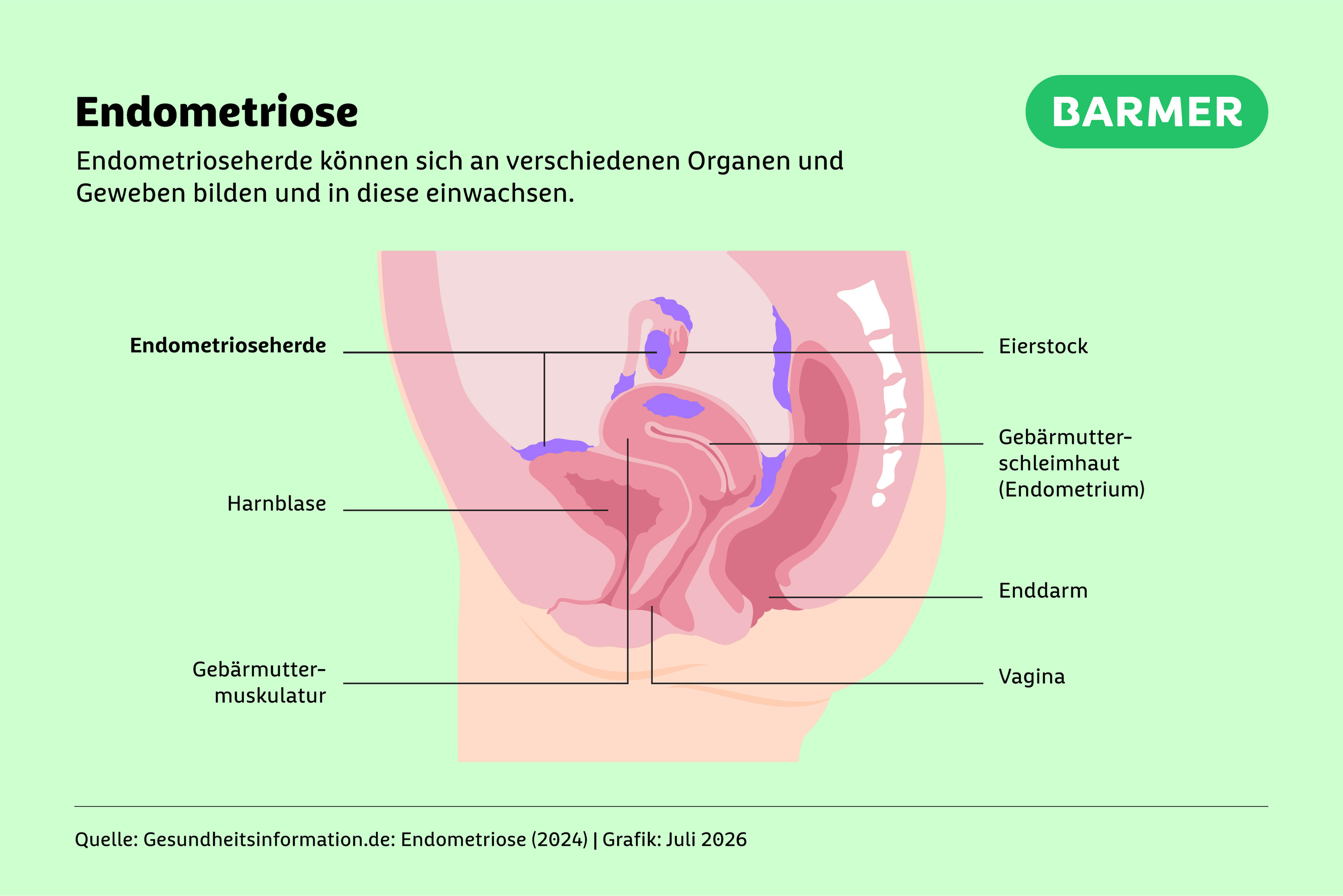 Illustration eines Querschnistts durch den weiblichen Unterleib mit Endometrioseherden