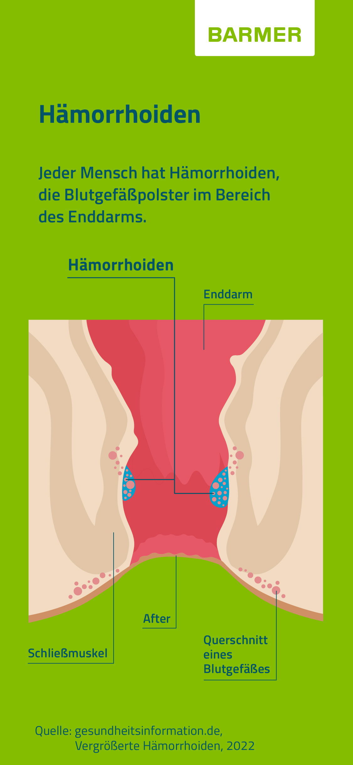 Illustration von Hämorrhoiden im Querschnitt eines Unterleibs