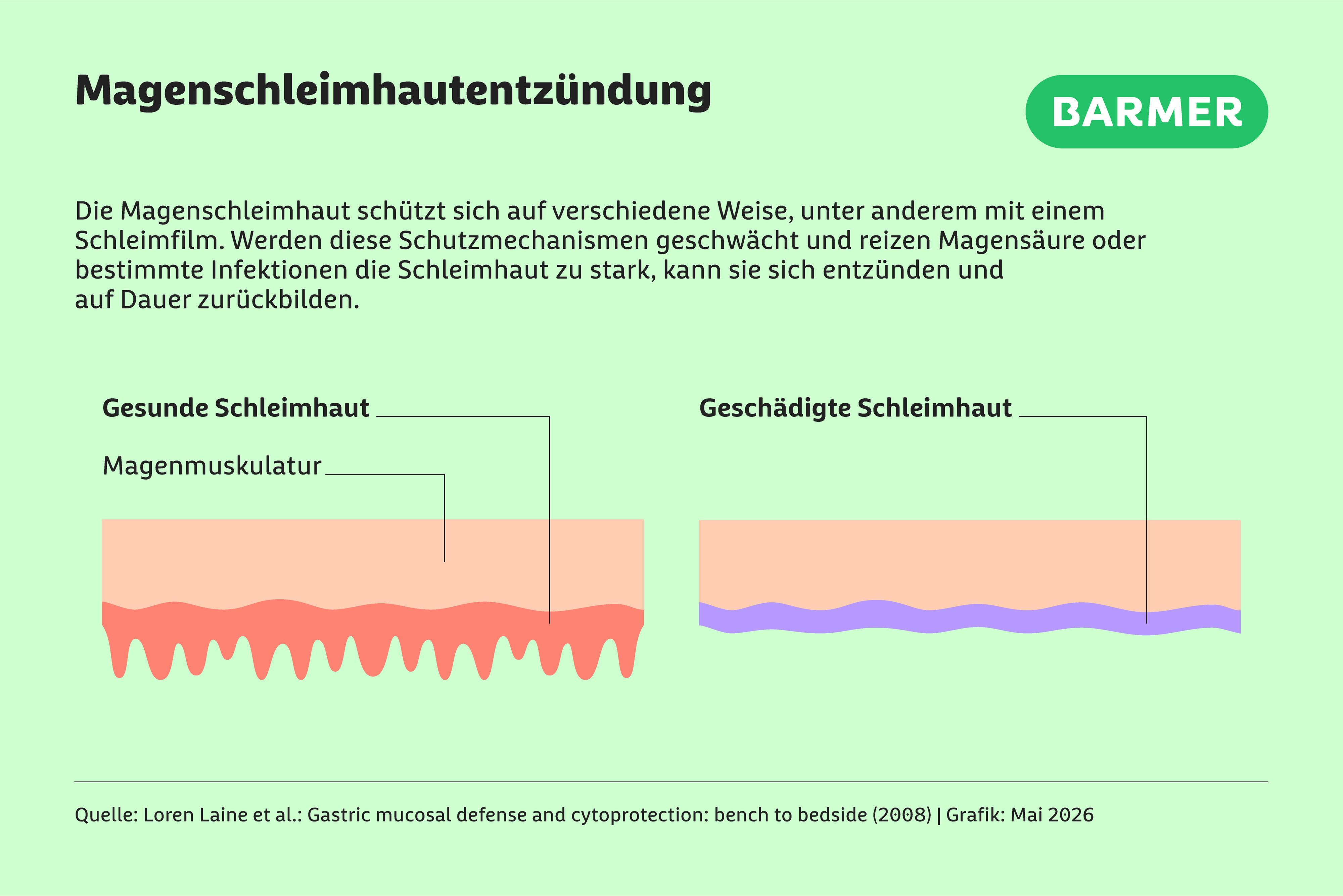 Infografik zur Magenschleimhautentzündung mit Vergleich von gesunder und geschädigter Schleimhaut und Darstellung des schützenden Schleimfilms.