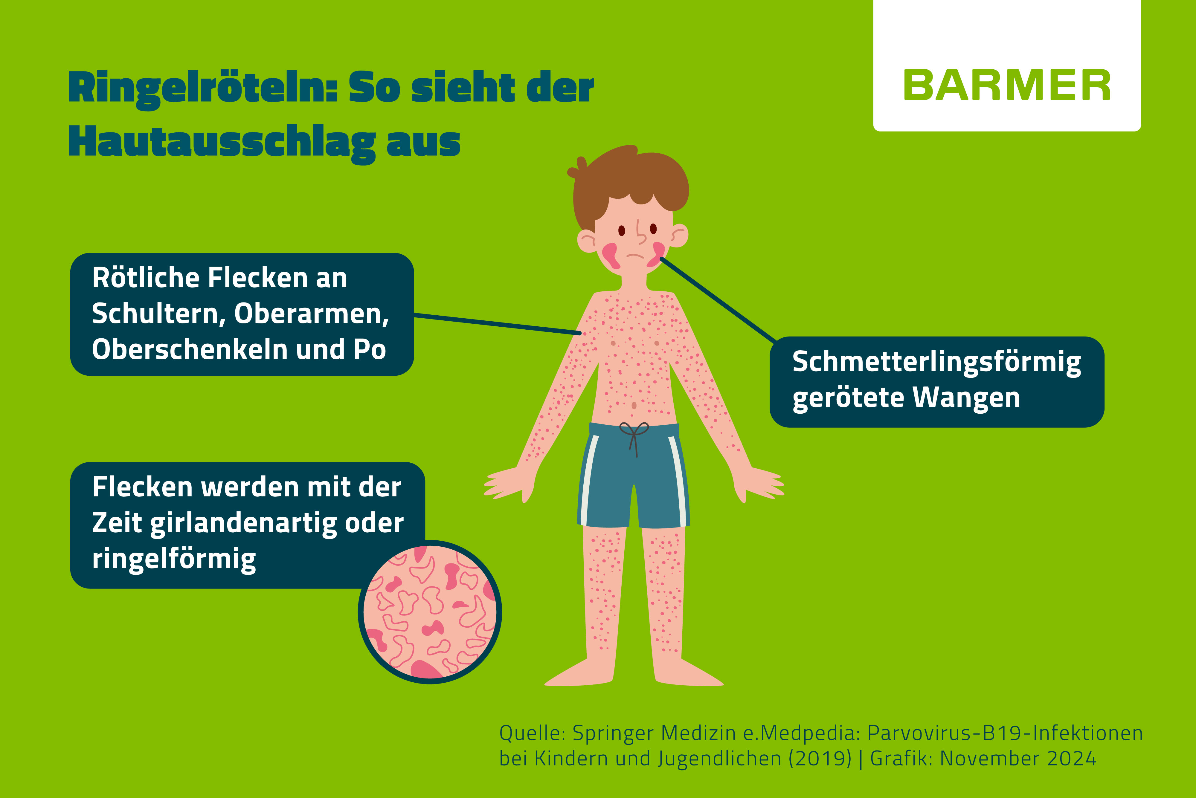 Ringelr teln Symptome Behandlung BARMER