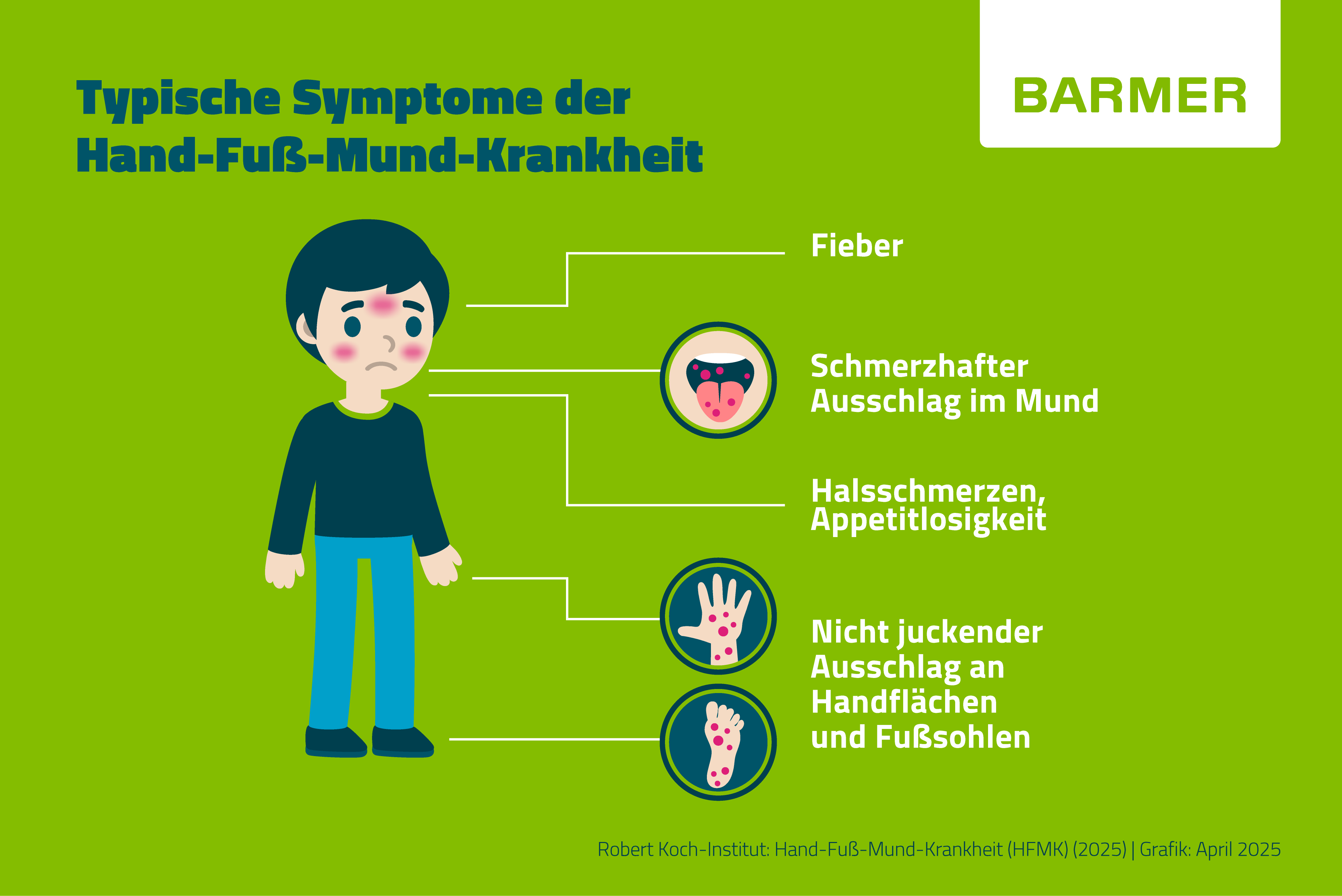 Infografik mit einem gezeichneten Kind und typischen Symptomen der Hand-Fuß-Mund-Krankheit: Fieber, schmerzhafter Ausschlag im Mund, Halsschmerzen und Appetitlosigkeit sowie nicht juckender Ausschlag an Handflächen und Fußsohlen.