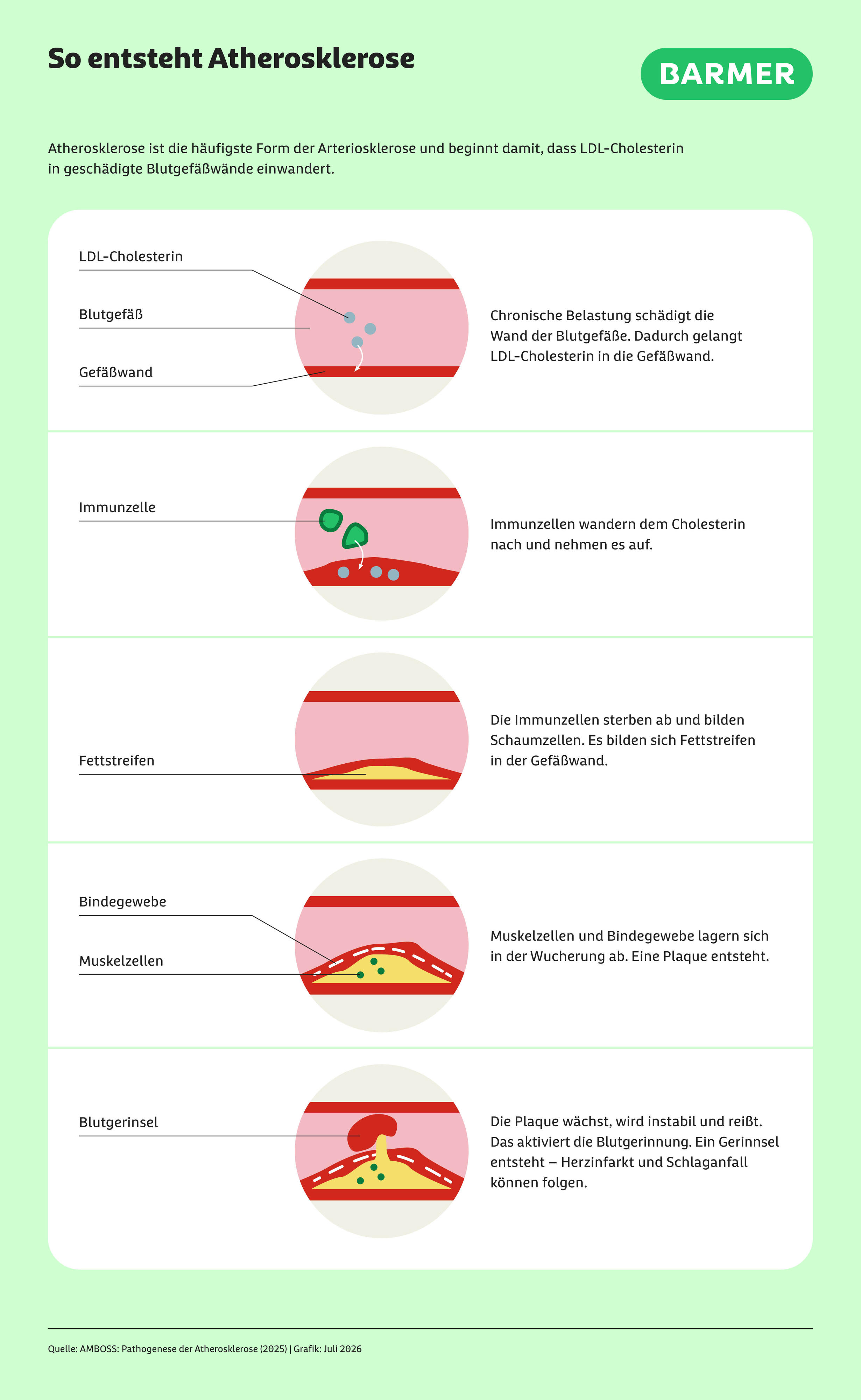 Infografik „So entsteht Atherosklerose“. Schrittweise wird gezeigt, wie sich LDL-Cholesterin in geschädigten Gefäßwänden ablagert, Immunzellen eindringen und Fettstreifen bilden. Darauf folgen Einlagerungen von Muskel- und Bindegewebe, die eine Plaque entstehen lassen. Diese kann wachsen, instabil werden und reißen, wodurch ein Blutgerinnsel entsteht. Mögliche Folgen: Herzinfarkt oder Schlaganfall.