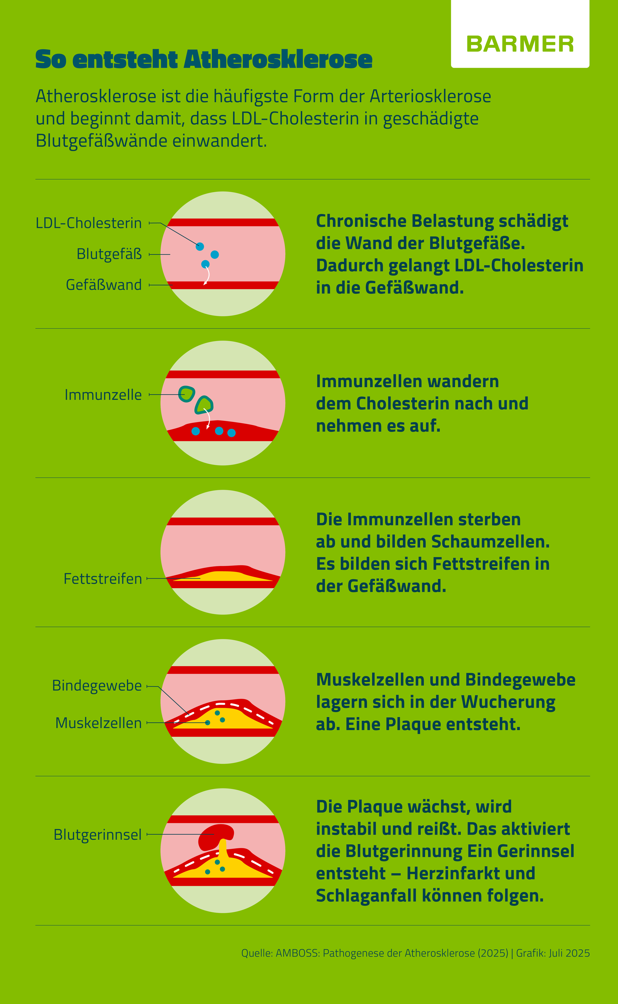 Infografik „So entsteht Atherosklerose“. Schrittweise wird gezeigt, wie sich LDL-Cholesterin in geschädigten Gefäßwänden ablagert, Immunzellen eindringen und Fettstreifen bilden. Darauf folgen Einlagerungen von Muskel- und Bindegewebe, die eine Plaque entstehen lassen. Diese kann wachsen, instabil werden und reißen, wodurch ein Blutgerinnsel entsteht. Mögliche Folgen: Herzinfarkt oder Schlaganfall.