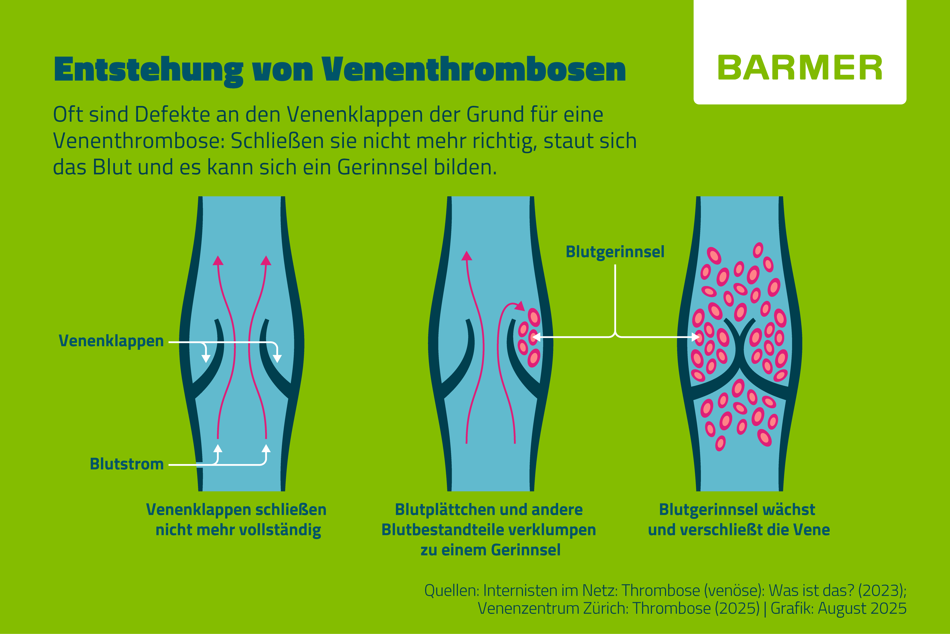 Infografik zur Entstehung von Venenthrombosen: Drei schematische Darstellungen einer Vene zeigen, wie defekte Venenklappen nicht mehr vollständig schließen, sich Blut staut und Blutplättchen verklumpen. Es entsteht ein Blutgerinnsel, das wächst und die Vene verschließt