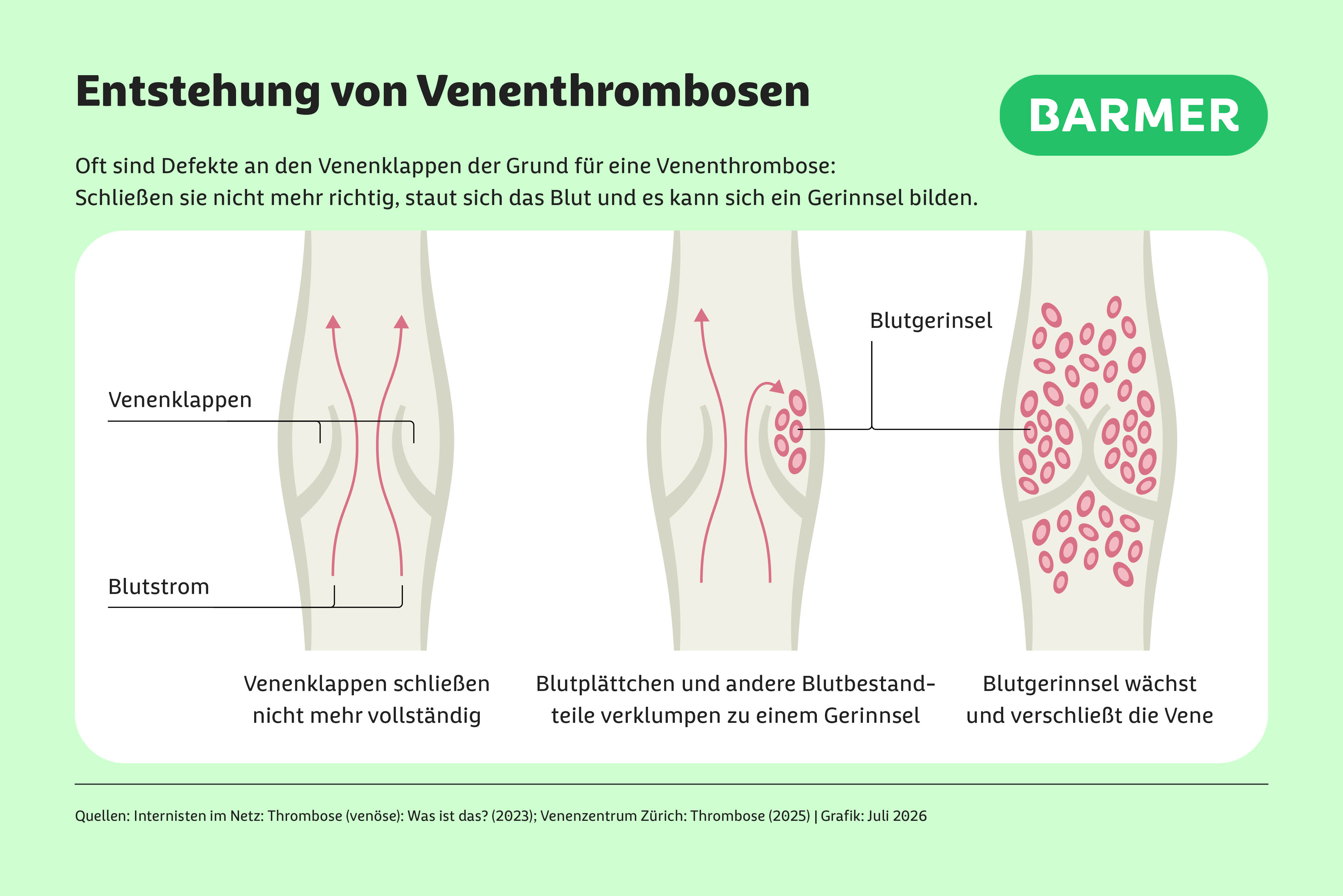 Infografik zur Entstehung von Venenthrombosen: Drei schematische Darstellungen einer Vene zeigen, wie defekte Venenklappen nicht mehr vollständig schließen, sich Blut staut und Blutplättchen verklumpen. Es entsteht ein Blutgerinnsel, das wächst und die Vene verschließt