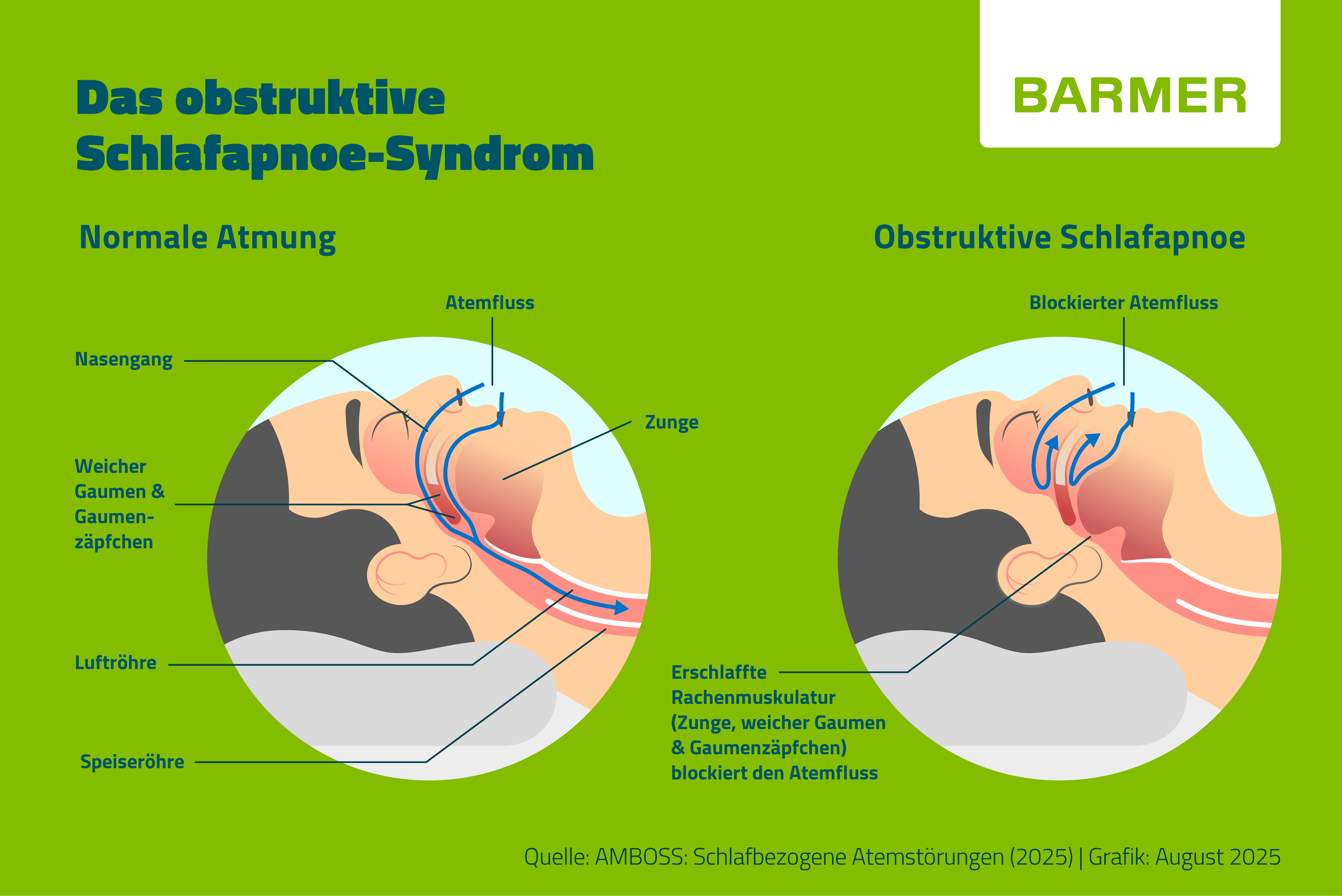 Infografik des obstruktiven Schlafapnoe-Syndroms: Darstellung rechts zeigt den Kopf einer schlafenden Person mit blockiertem Atemfluss mit erschlaffter Rachenmuskulatur. Links zeigt den normalen Atemfluss.