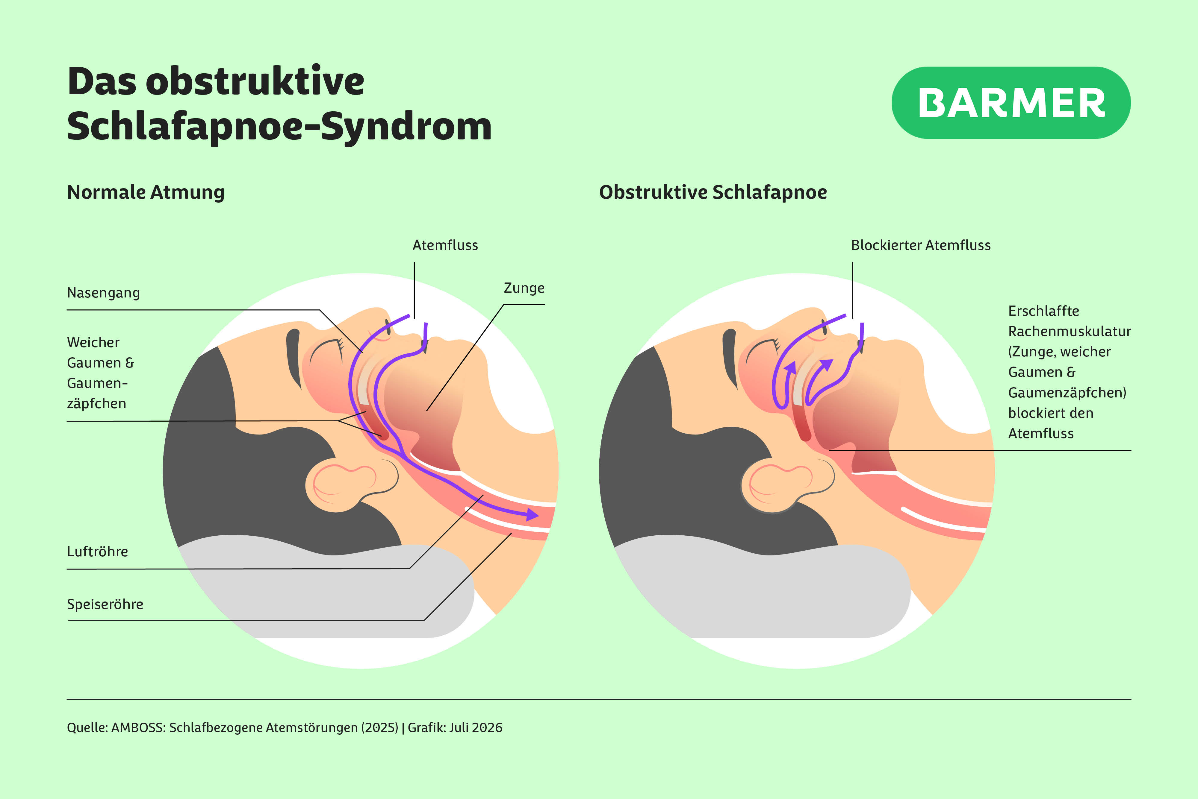 Infografik des obstruktiven Schlafapnoe-Syndroms: Darstellung rechts zeigt den Kopf einer schlafenden Person mit blockiertem Atemfluss mit erschlaffter Rachenmuskulatur. Links zeigt den normalen Atemfluss.
