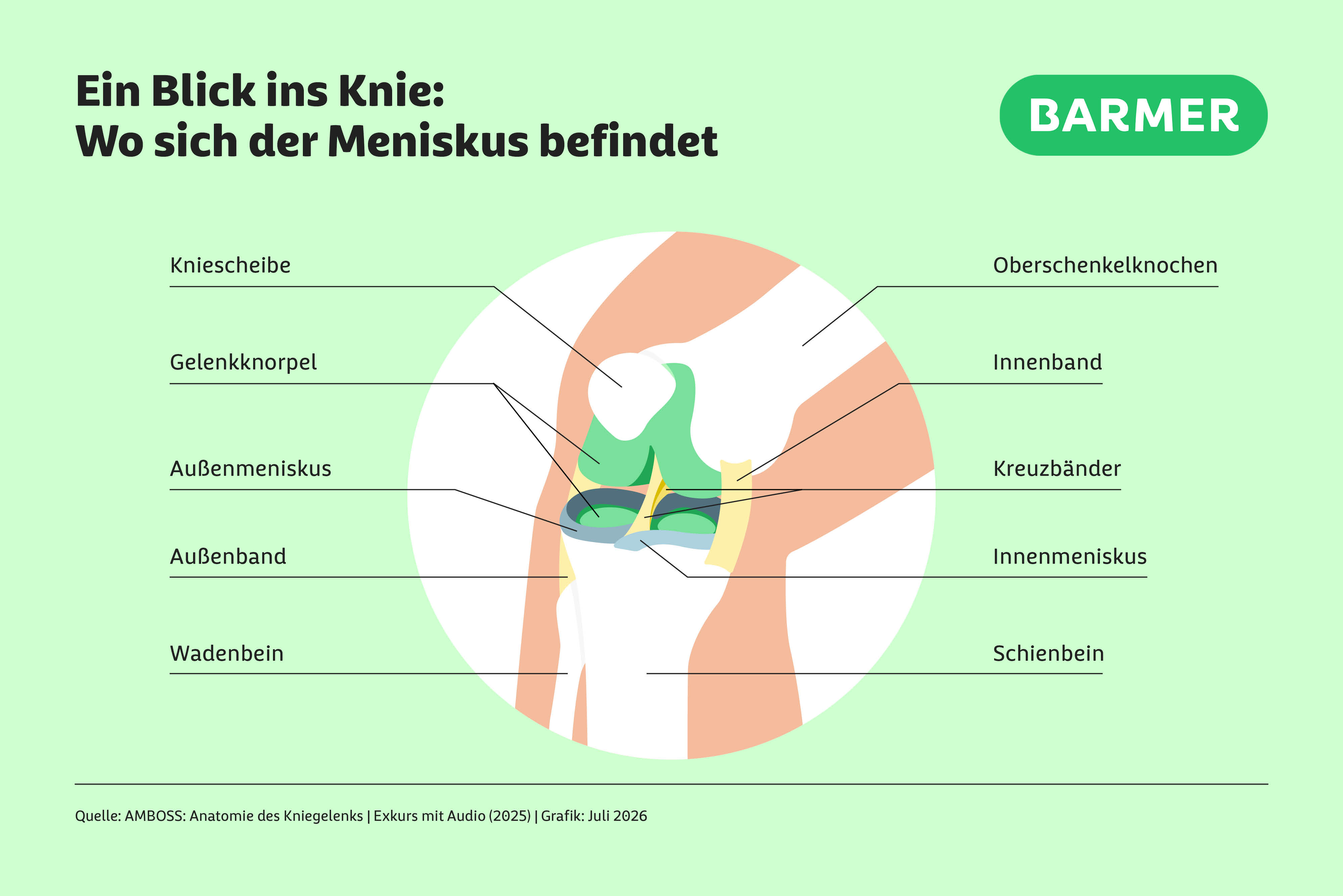 Infografik: Lage des Meniskus im Knie zwischen Oberschenkelknochen und Schienbein