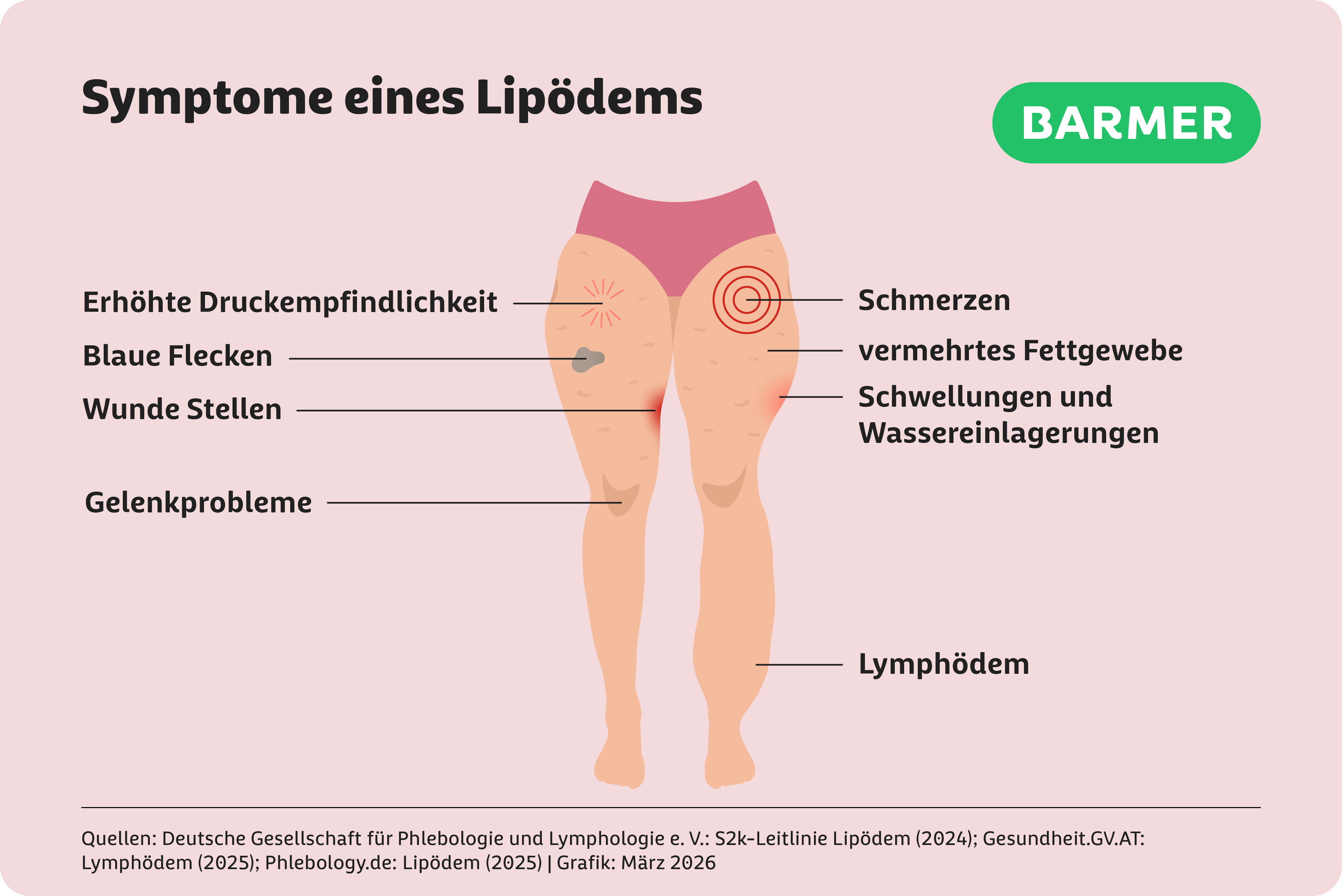 Infografik zu Lipödem-Symptomen mit markierten Beinen und Hinweisen auf Schmerzen, Druckempfindlichkeit, Hämatome, Schwellungen und Fettvermehrung.