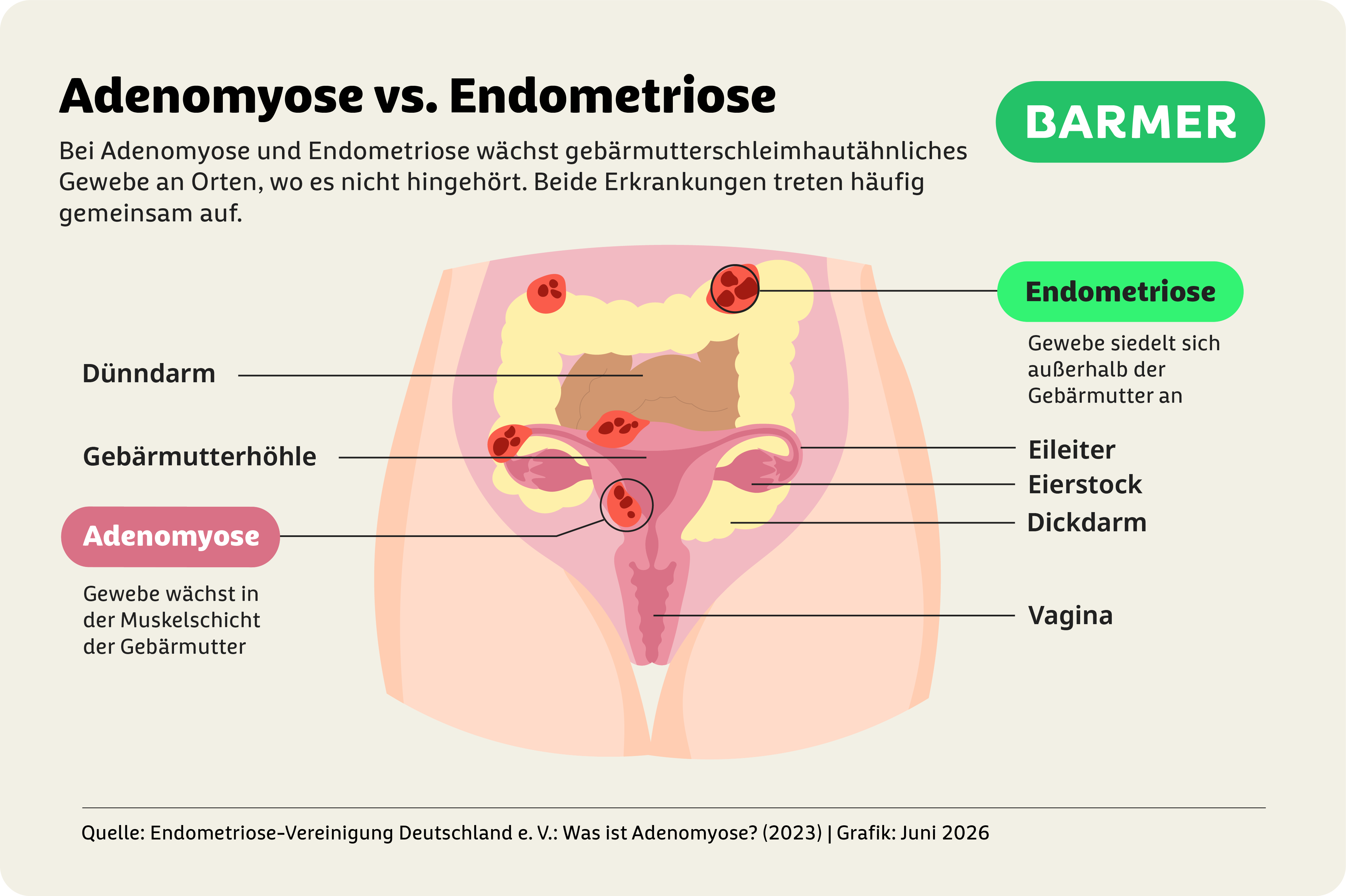 Die Grafik beschriebt, wo Adenomyose auftritt und was der Unterschied zur Endometriose ist