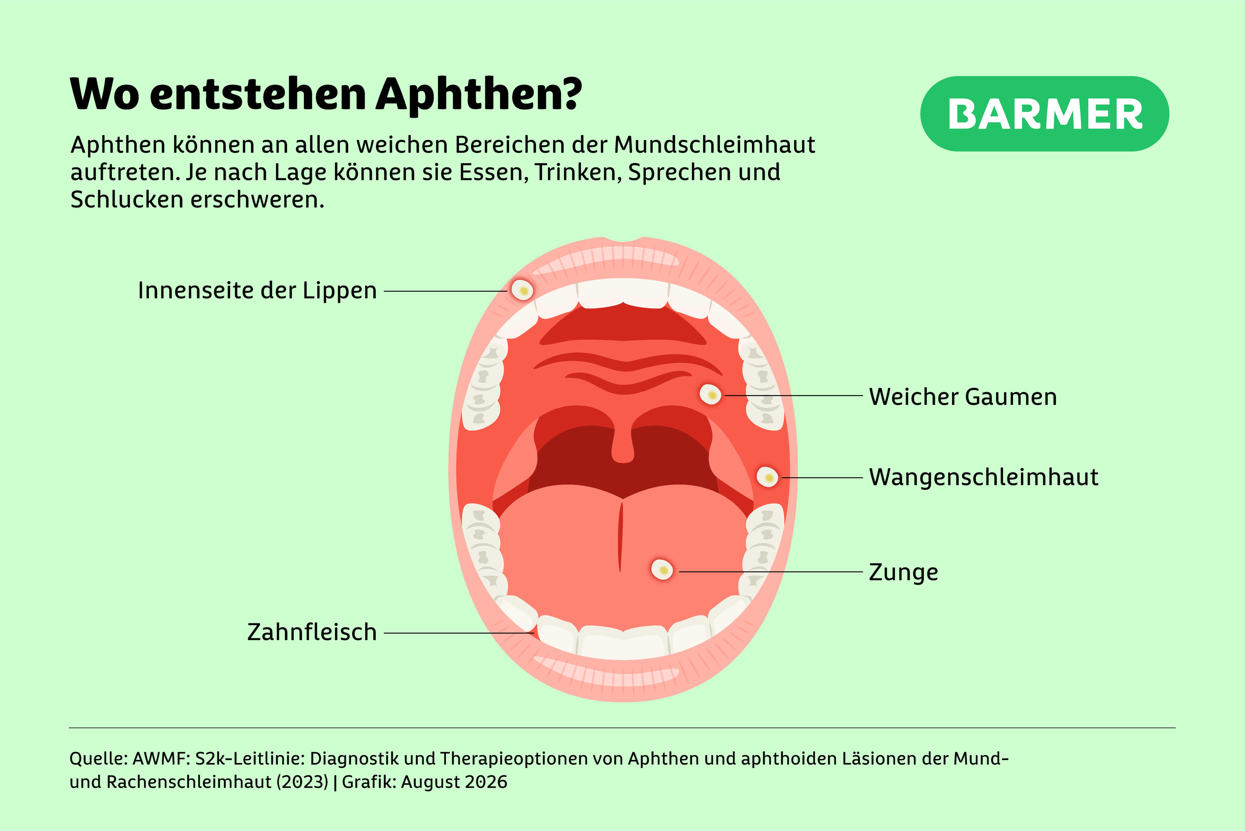 Infografik „Wo entstehen Aphthen?“. Dargestellt ist eine geöffnete Mundhöhle mit markierten Bereichen, an denen Aphthen häufig auftreten können. Hervorgehoben sind die Innenseite der Lippen, der weiche Gaumen, die Wangenschleimhaut, die Zunge und das Zahnfleisch. Die markierten Stellen sind durch Beschriftungen und Linien den jeweiligen Bereichen im Mund zugeordnet. Die Grafik stammt von der Barmer.