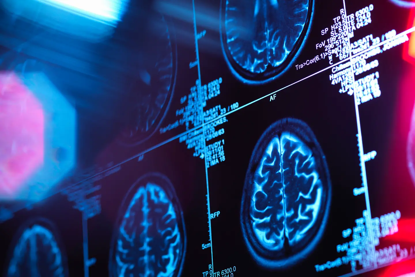 Stilisierte Darstellung eines Gehirn-Scans