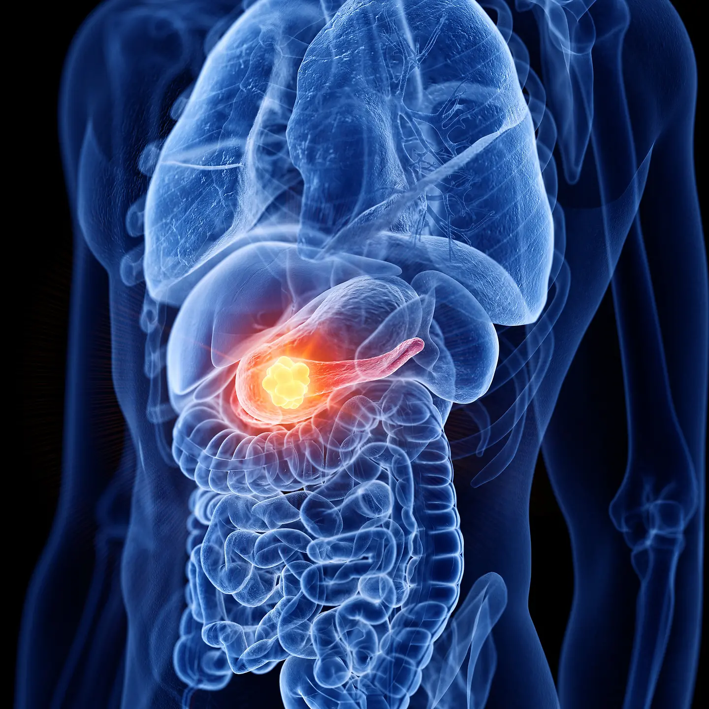 Stilisierte Darstellung einer Bauchspeicheldrüse mit Tumorerkrankung