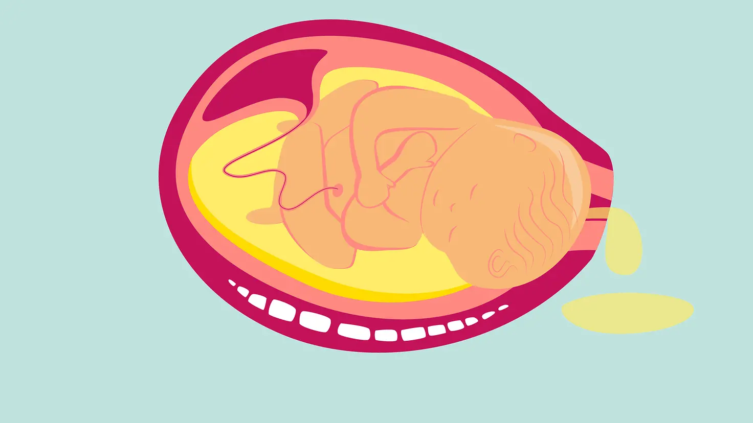 Illustration Eröffnungsphase der Geburt: Nach und nach öffnet sich der Muttermund.