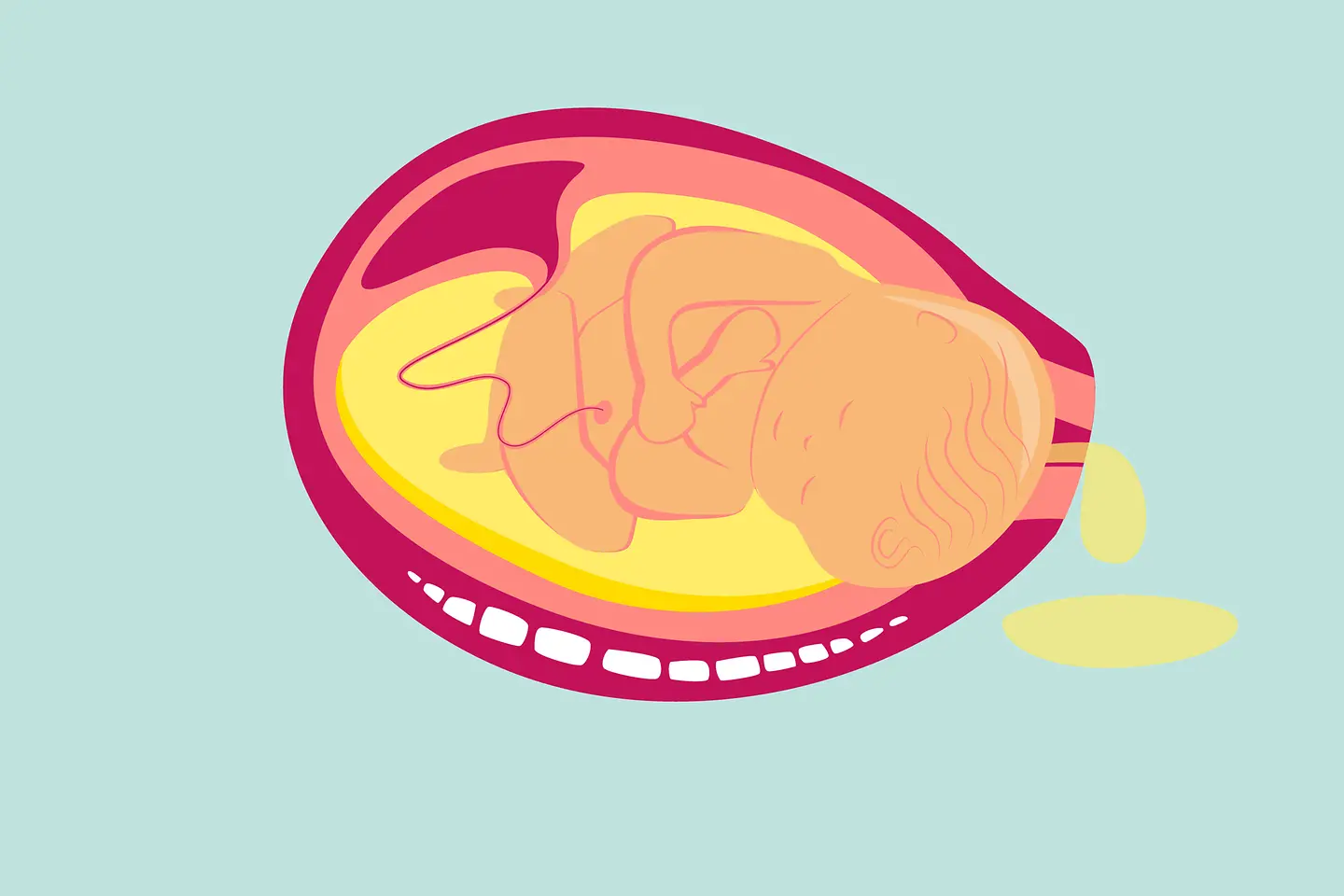 Illustration Eröffnungsphase der Geburt: Nach und nach öffnet sich der Muttermund.