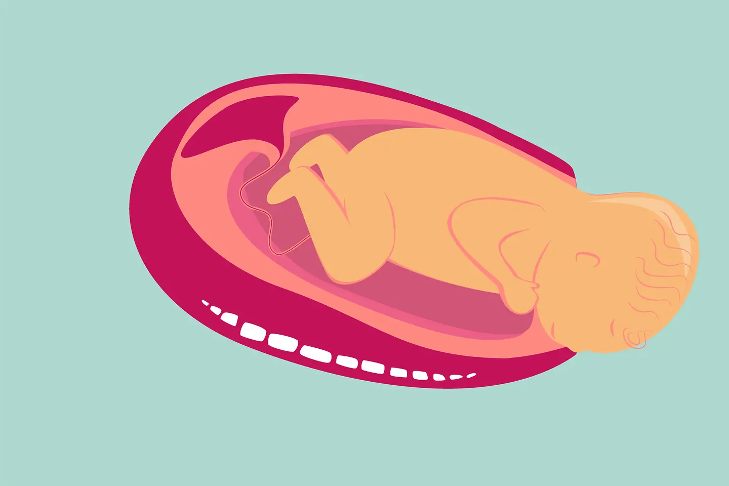 Illustration Austreibunsphase der Geburt: Zuerst wird das Köpfchen geboren.