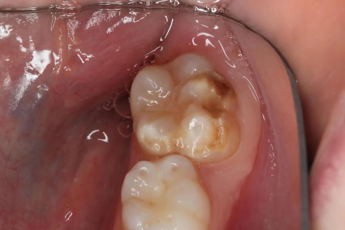 Blick in einen Kindermund mit Zähnen, die eine moderate Form der MIH aufweisen
