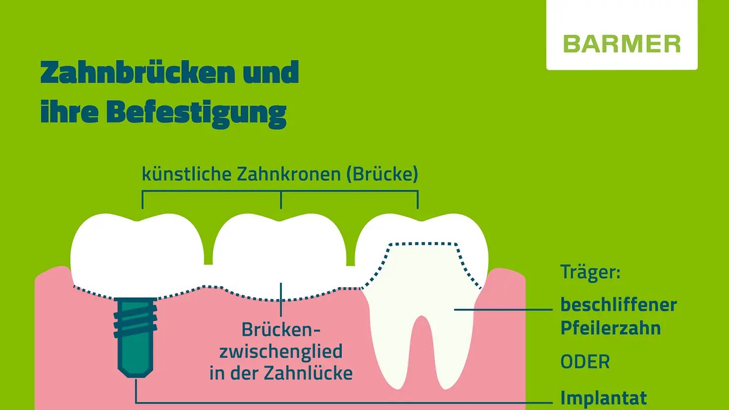 Kleine BARMER-Infotafel zum Thema: Zahnbrücken und Ihre Befestigung
