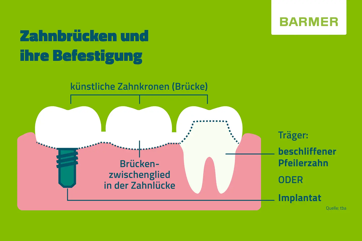 Kleine BARMER-Infotafel zum Thema: Zahnbrücken und Ihre Befestigung