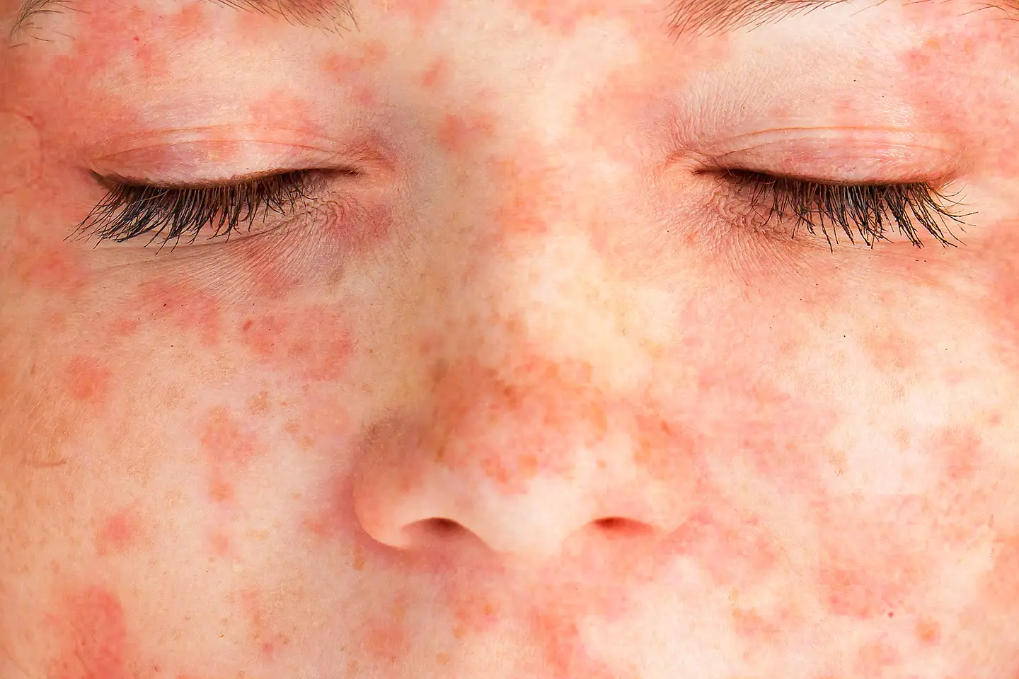 Das Bild zeigt ein Gesicht mit Neurodermitis.