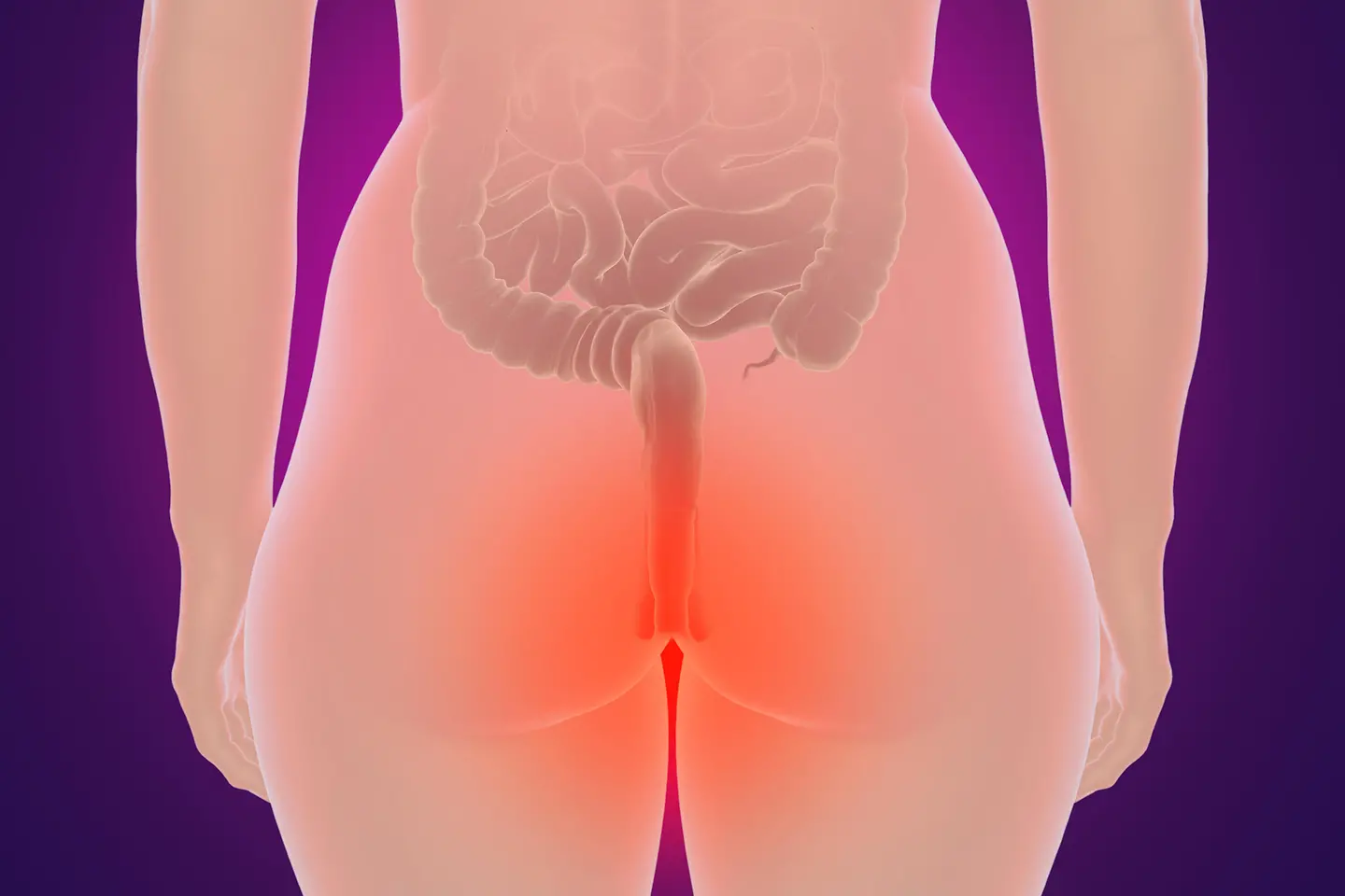 Das Symbolbild zeigt Hämorrhoiden bei einer Frau.