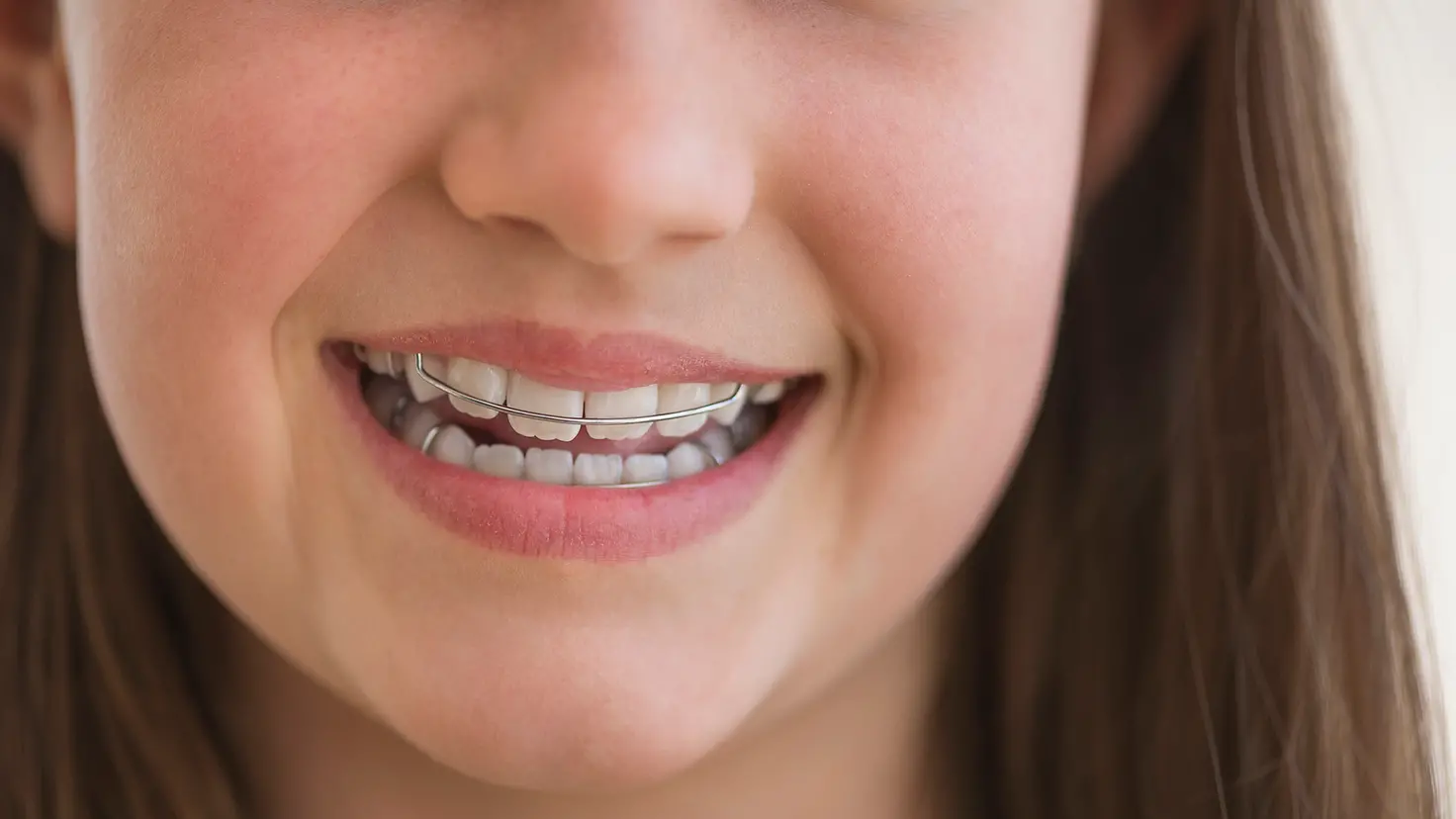 Junges Mädchen lächelt und trägt eine lose Zahnspange.