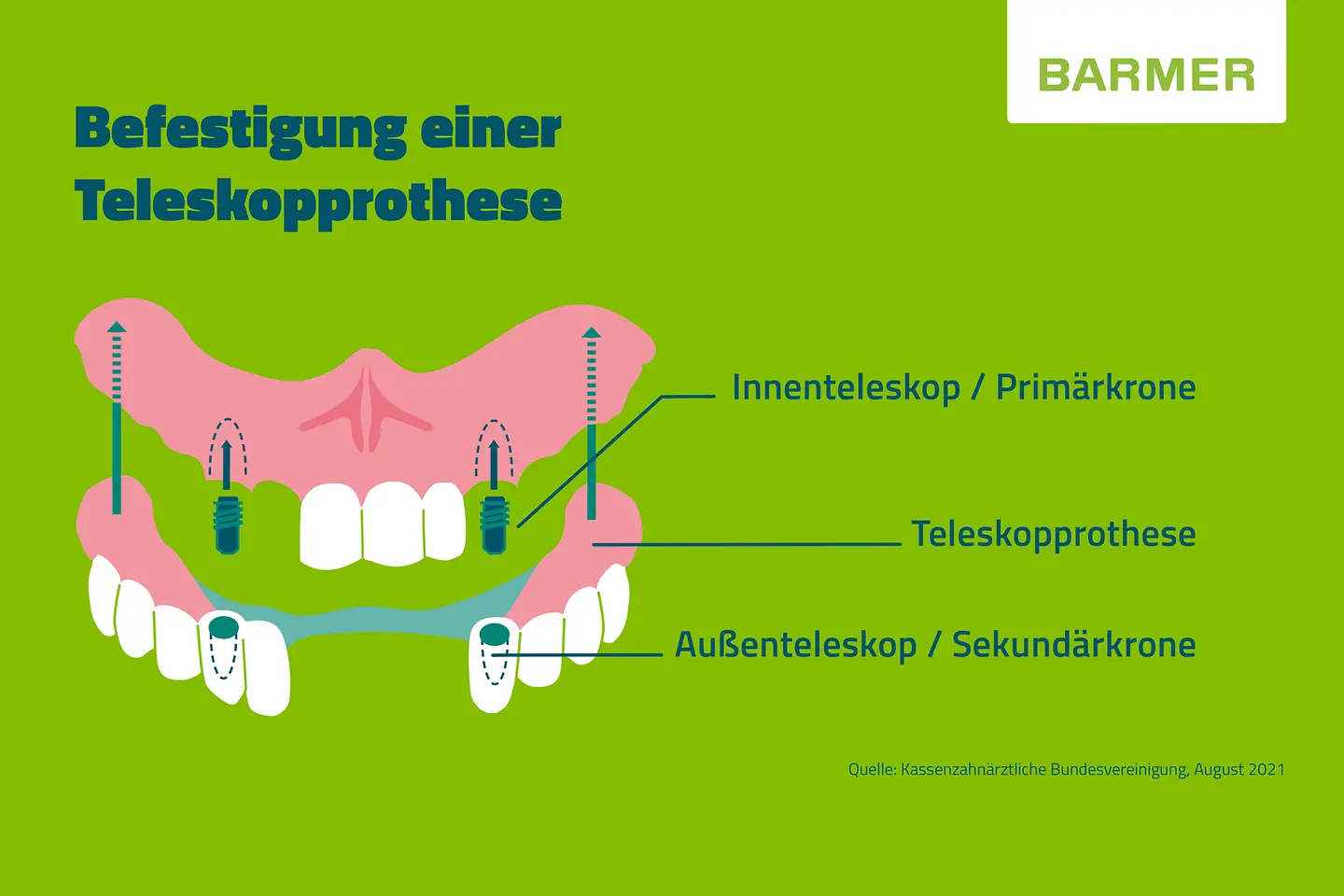 Kleine BARMER-Infotafel zum Thema: Zahnbrücken und Ihre Befestigung