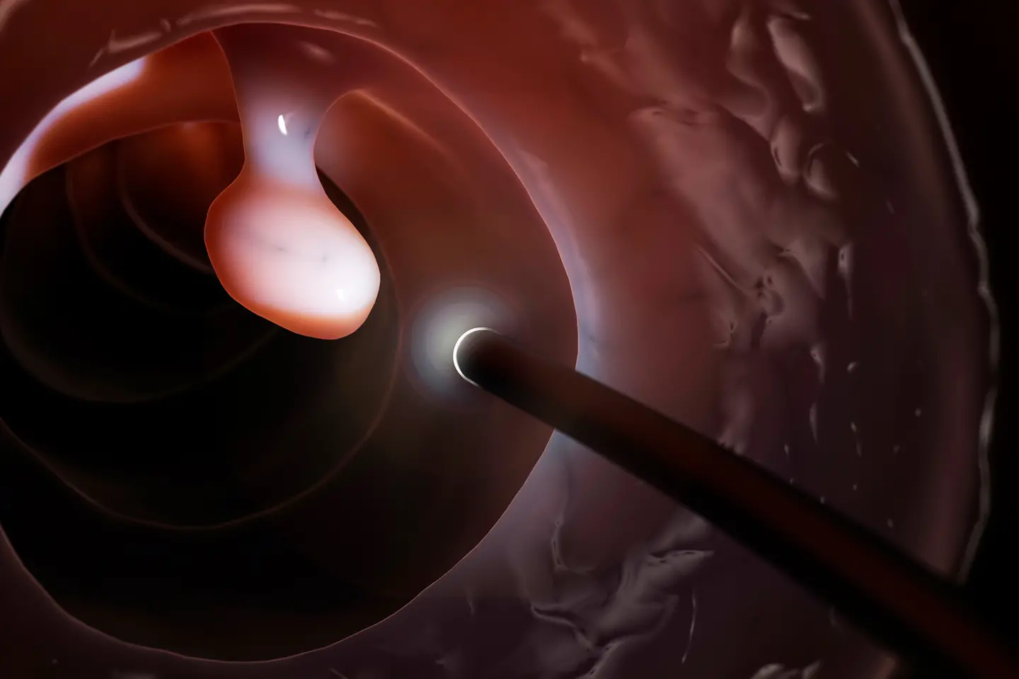 Wucherung am Inneren einer Darmschleimhaut