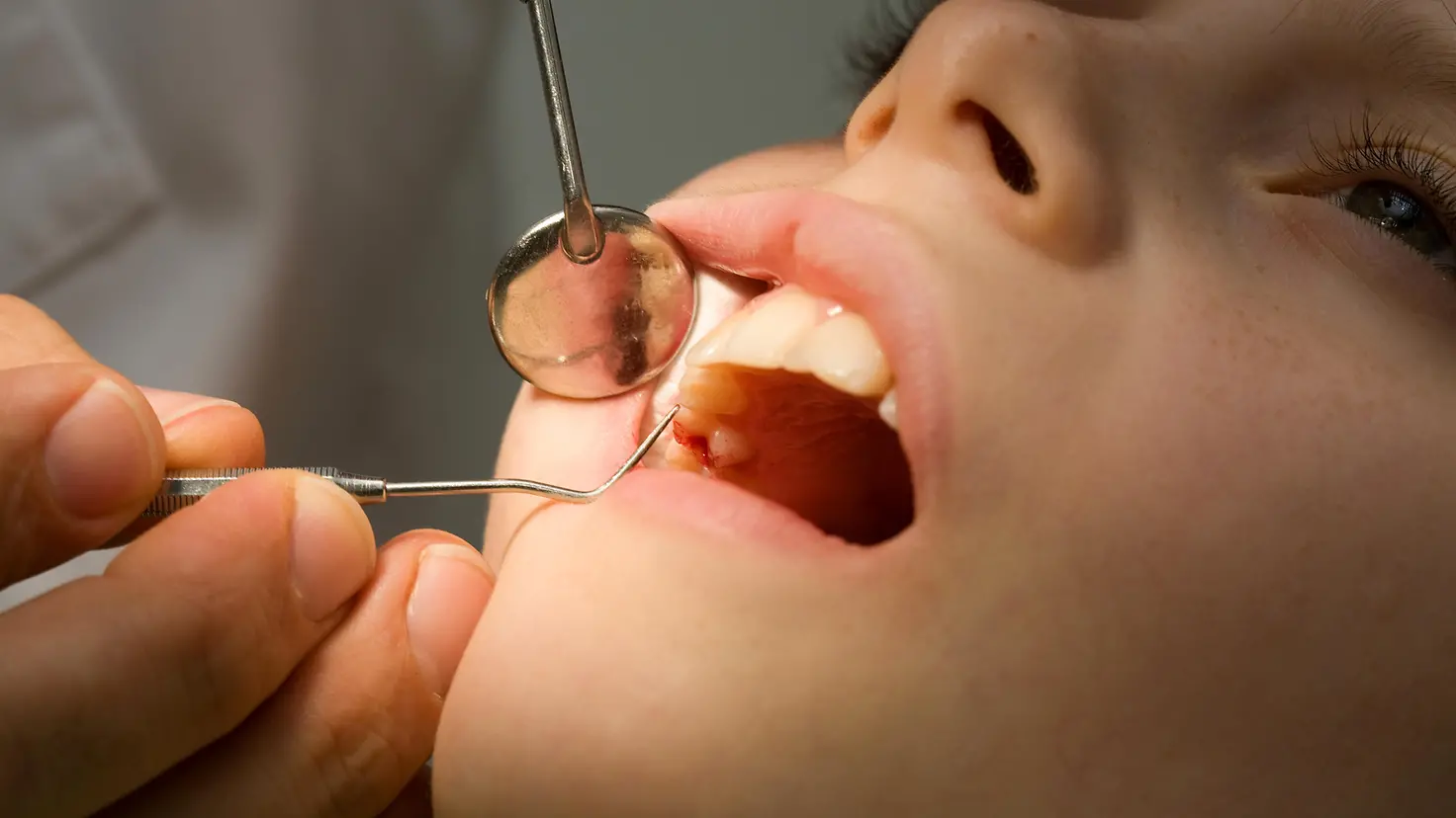 Ein Kind hat den Mund geöffnet und wird zahnärztlich untersucht.