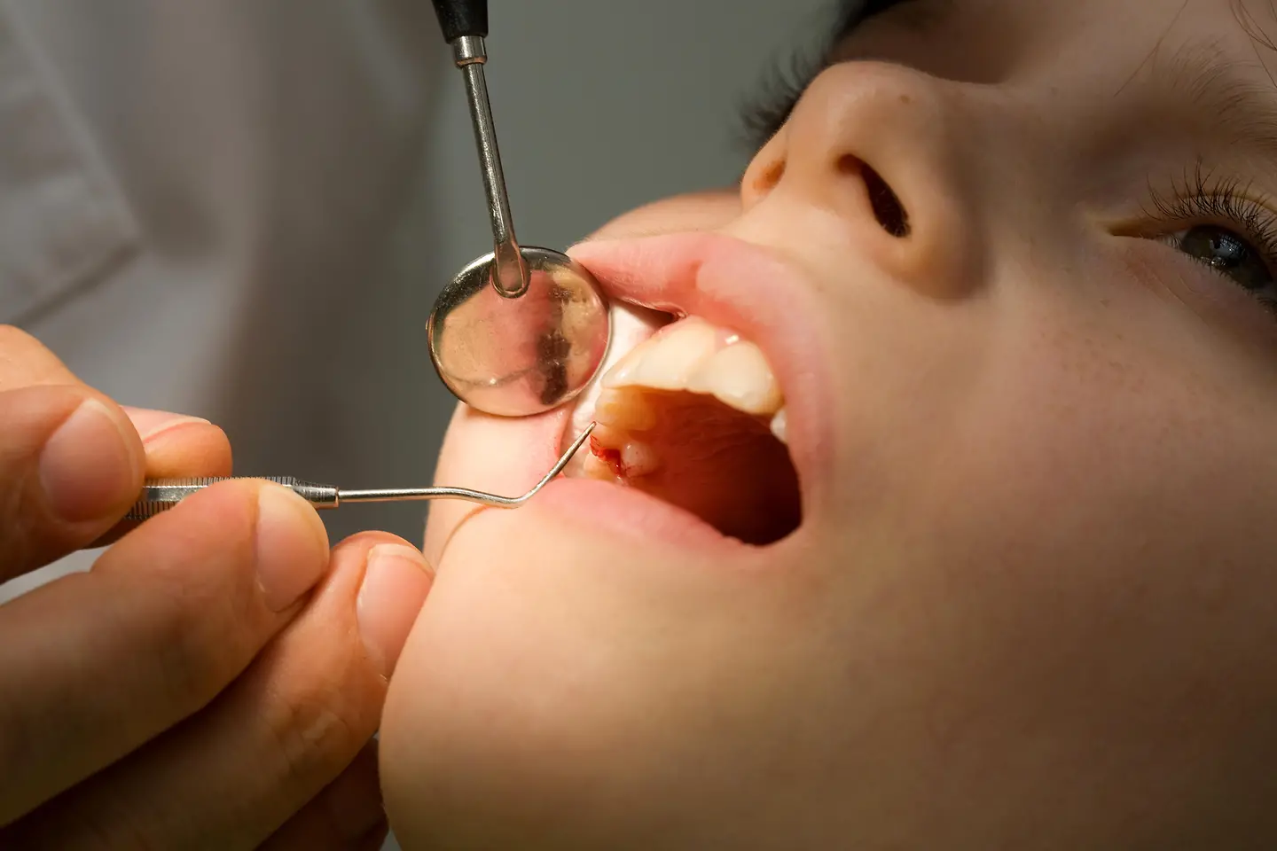 Ein Kind hat den Mund geöffnet und wird zahnärztlich untersucht.