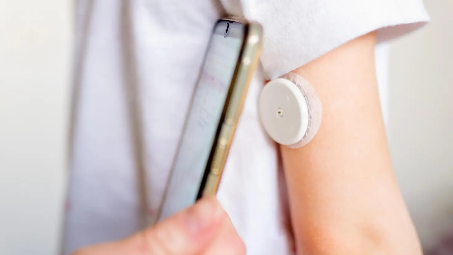 Blutzuckermessung am Arm mit kontinuierlichem Glukosemess-System und Smartphone