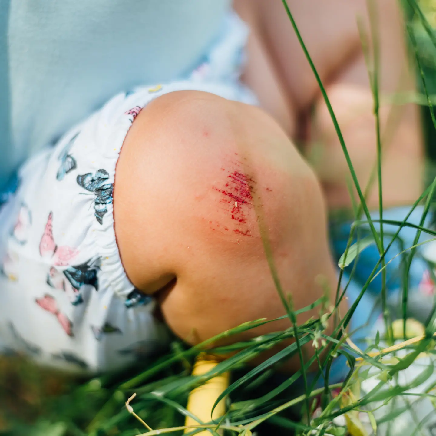 Ein Kind sitzt im Gras mit kurzer Hose. Sein Knie ist aufgeschürft und blutet.