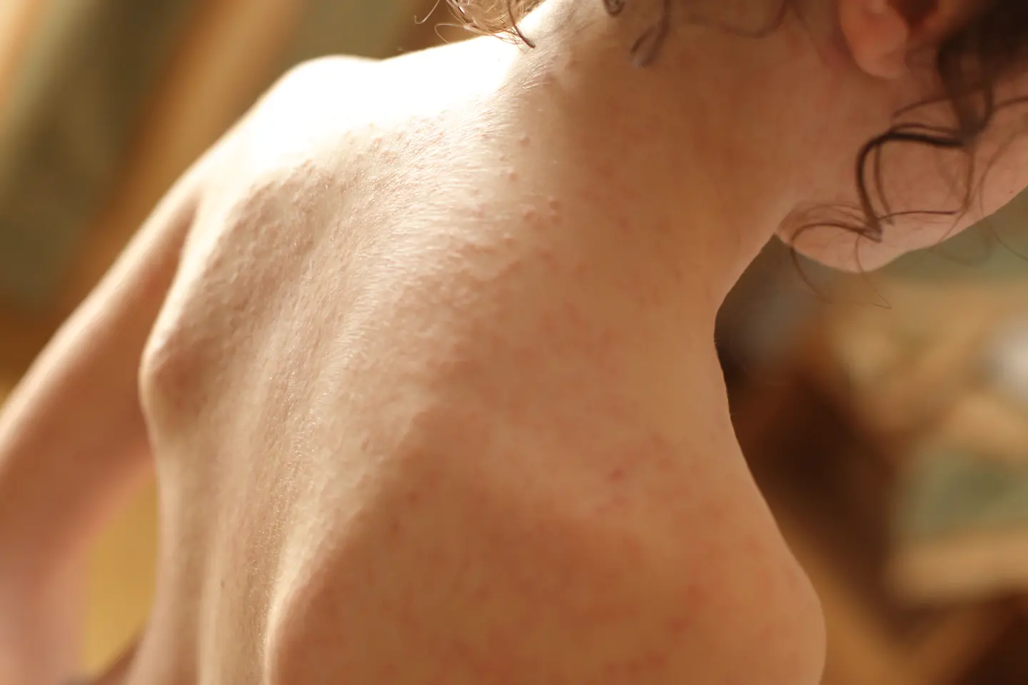 Nackter Rücken eines Kindes mit Hautausschlag, der für Drei-Tage-Fieber charakteristisch ist.