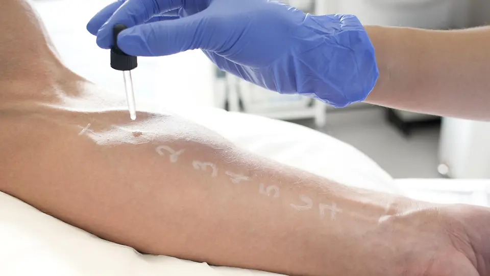 Wo kann man einen Allergietest machen? BARMER