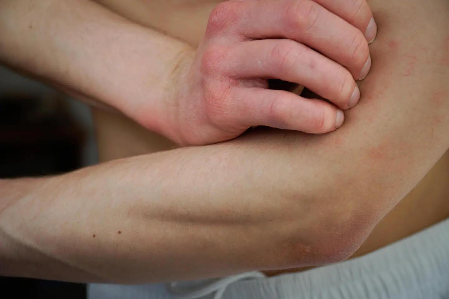Zu sehen ist eine Person mit Neurodermitis die sich kratzt