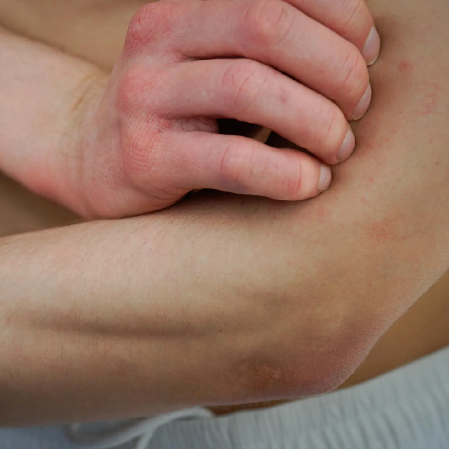Zu sehen ist eine Person mit Neurodermitis die sich kratzt