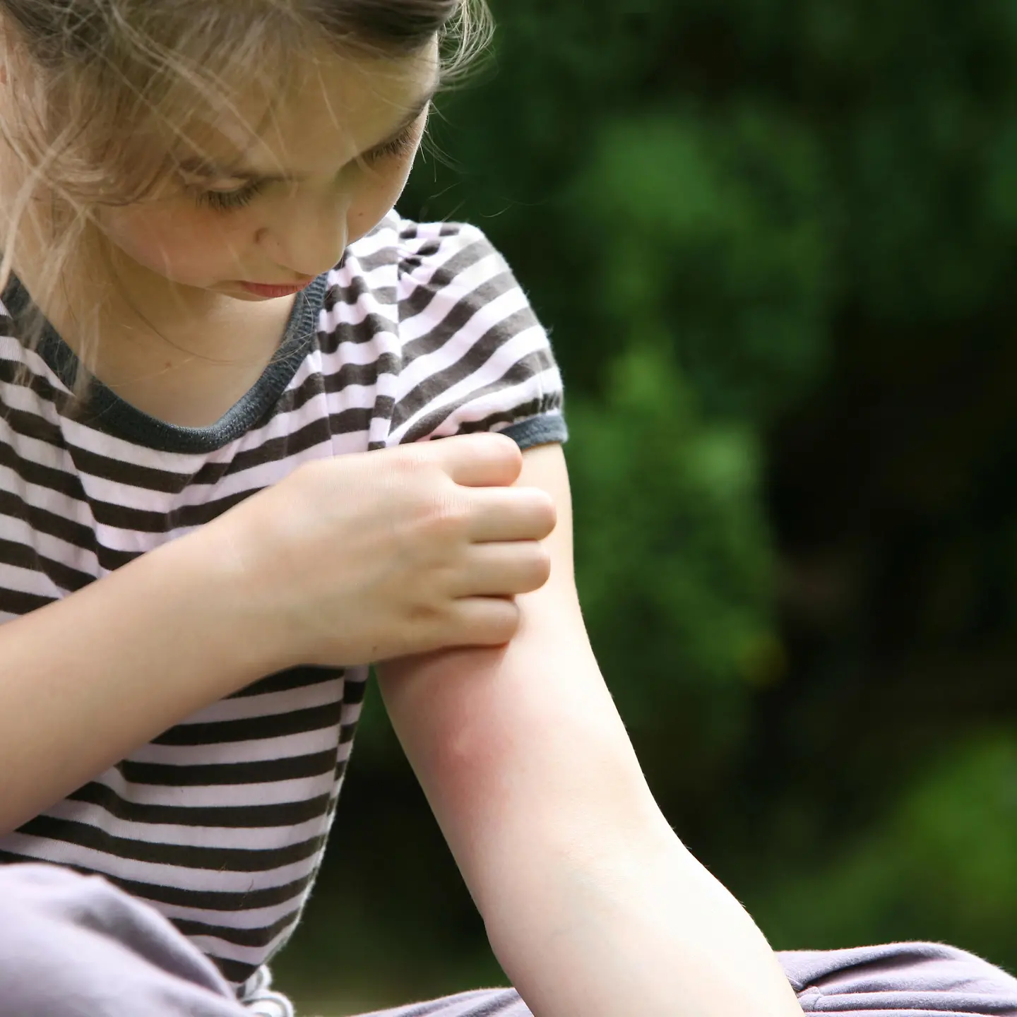 junges Mädchen kratzt an ihrer allergischen Reaktion