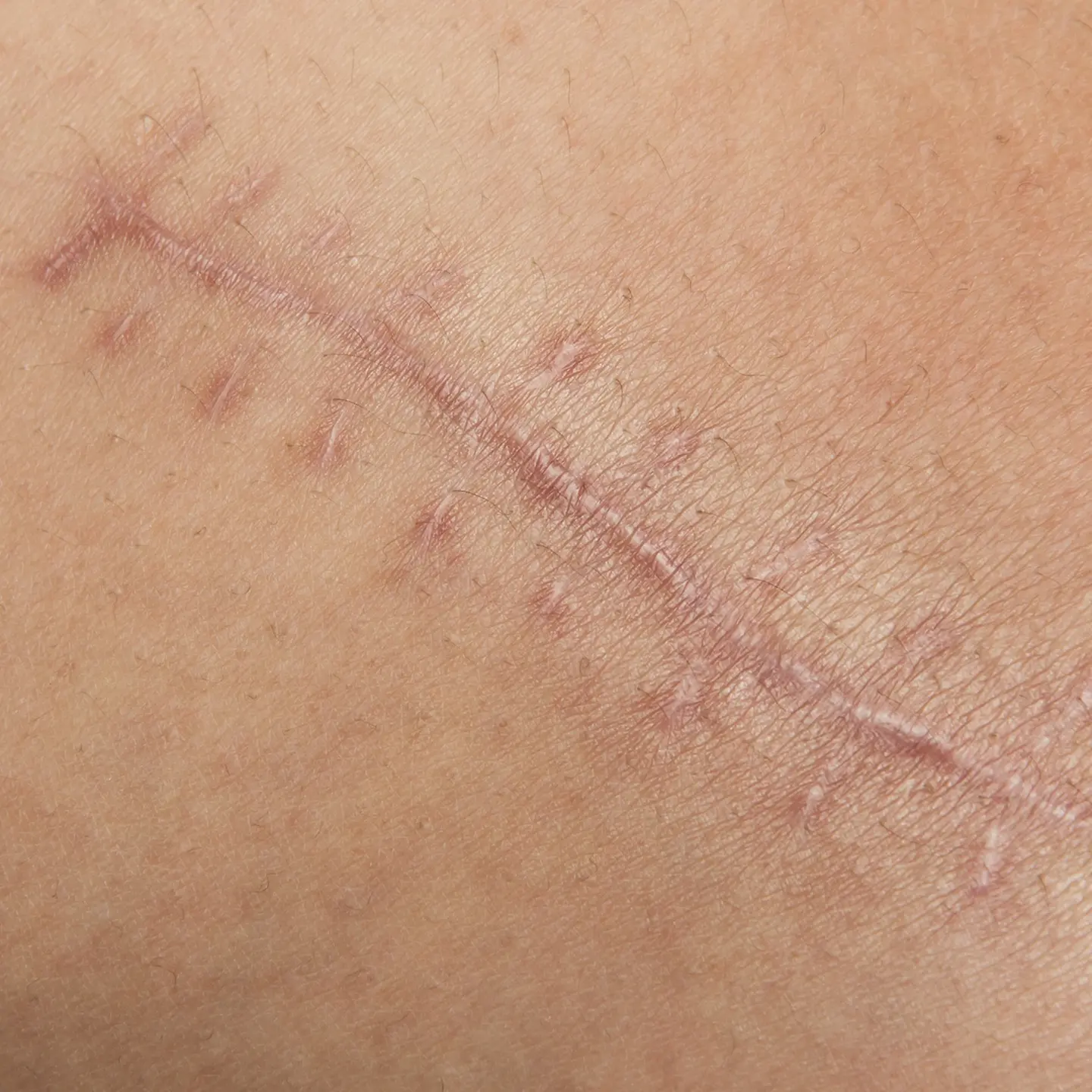 Zu sehen auf diesem Foto ist eine gut sichtbare und verheilte Narbe auf menschlicher Haut. Ganze neun Stiche wurden für die Naht verwendet. 